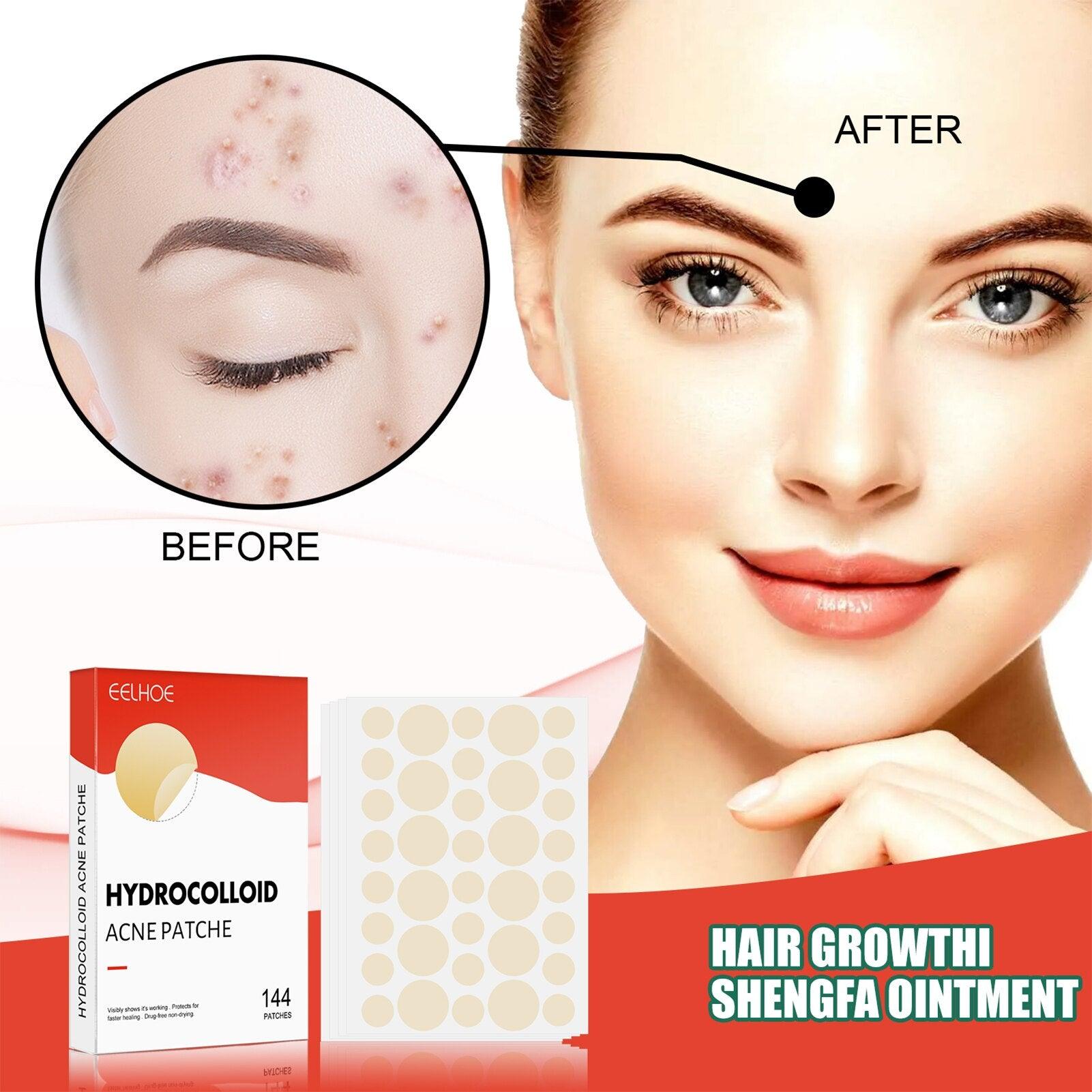 Hydrocolloid Acne Patch - Puritific