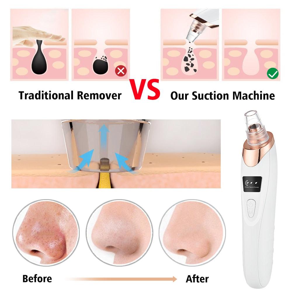 Vacuum Electric Blackhead Remover Cleaner - Puritific